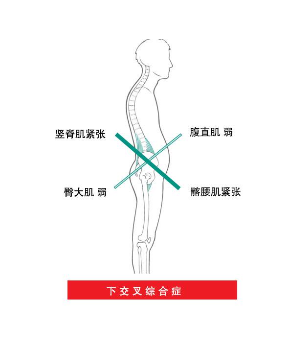 下交叉症候群：久坐族最常見的骨盆前傾問題