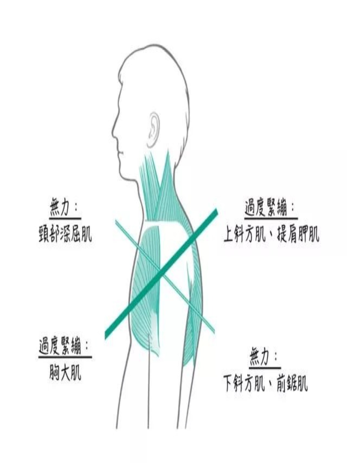 肩頸痠痛與手麻處理
